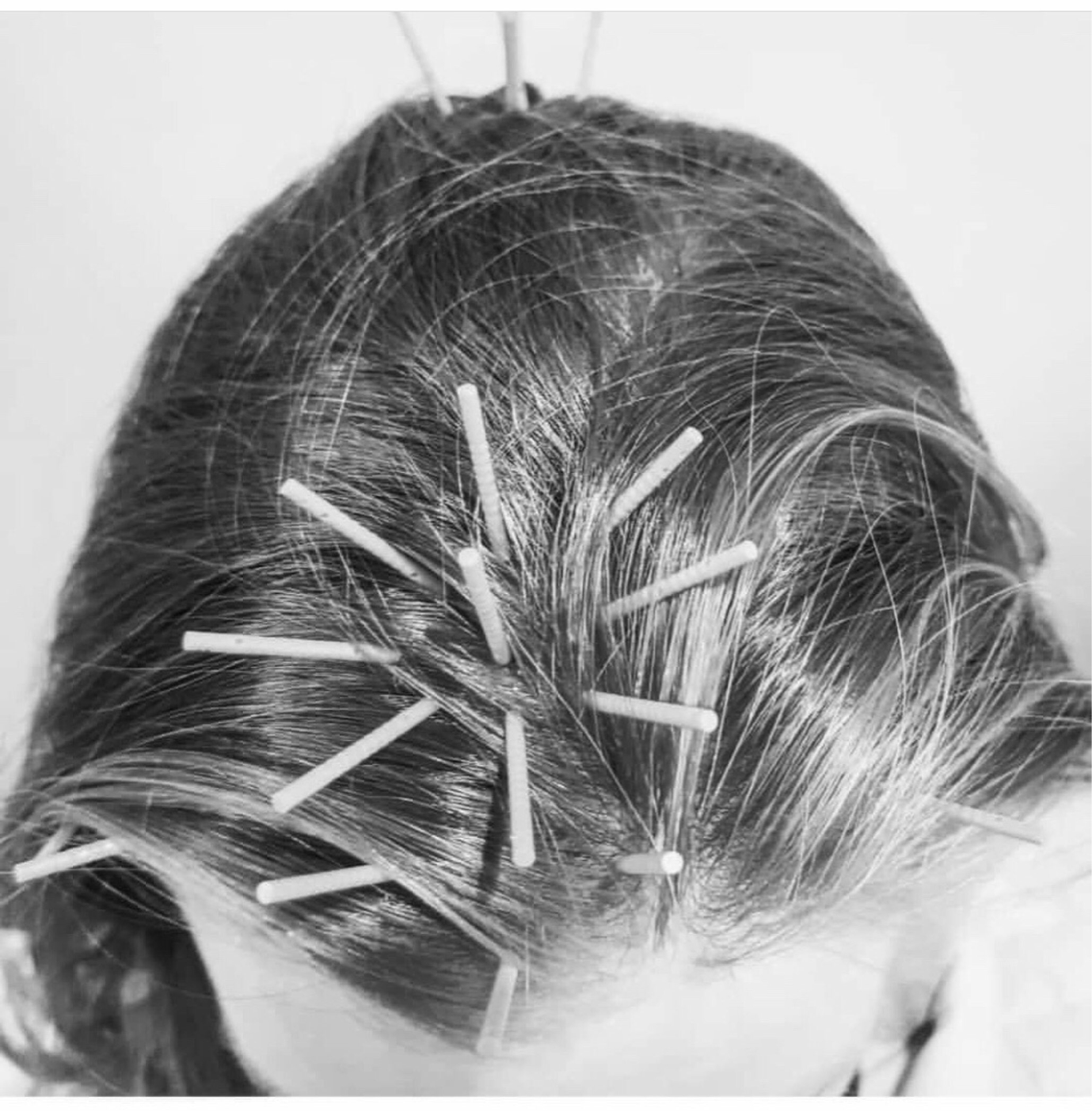 About scalp acupuncture treatment