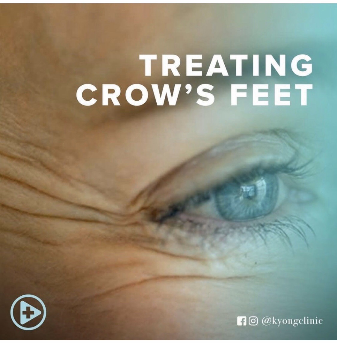 How to remove crow\'s feet wrinkles naturally?