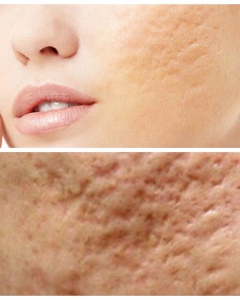 3 SKIN AESTHETICS TREATMENT TECHNOLOGIES FOR PERENNIAL PITTING SCARS