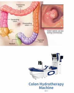 Colon hydrotherapy: basic information