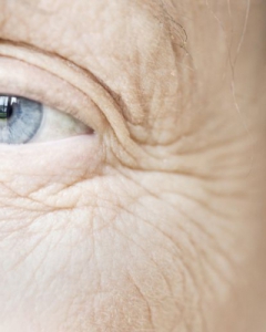 Different Types Of Wrinkles And Remedies