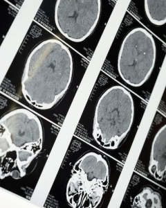 First Vaccine prolongs Brain Cancer survival