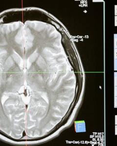 Israeli scientists successfully develop 3D printed model of brain tumor