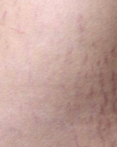 Purple Stretch Marks: Causes and treatments