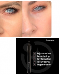 REMOVE EYELID WRINKLES AND SAG SKIN REJUVENATION WITH PLASMA PEN TREATMENT